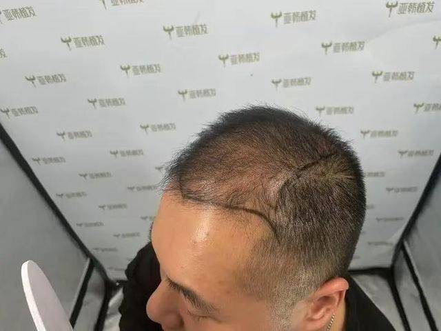 “还能反光<strong></p>
<p>bleutrade交易平台</strong>！”长沙男子植发近9月称后脑勺“像狗啃过”