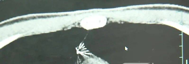 17岁小伙参军体检发现胸腔内有根5cm缝衣针<strong></p>
<p>奥德赛虚拟币</strong>,父母回忆或是1岁时扎入,取出时已锈迹斑斑