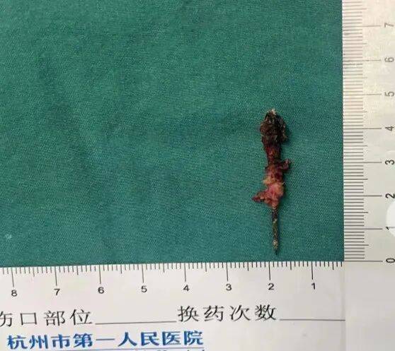 17岁小伙参军体检发现胸腔内有根5cm缝衣针<strong></p>
<p>奥德赛虚拟币</strong>,父母回忆或是1岁时扎入,取出时已锈迹斑斑